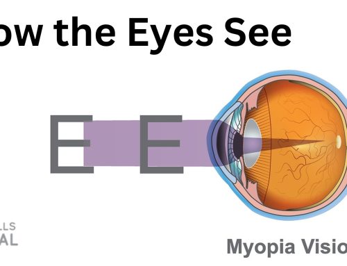 How the Eyes See: Part I Myopia