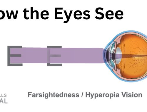 How the Eyes See: Part II Hyperopia
